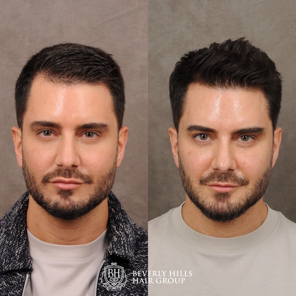Hair Transplant Hairline Lowering Before Afters Beverly Hills