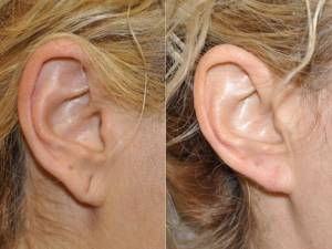 Torn or stretched ear lobes a problem? Don't worry, we have a