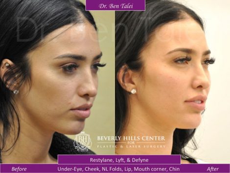 Facial Sculpting-Face Lift, Non-Surgical Facial Aesthetics