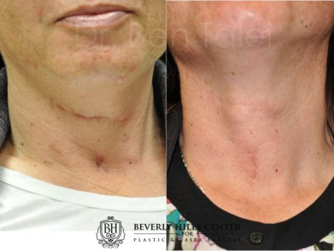 Scar, Piercing & Mole Removal – Before & Afters 