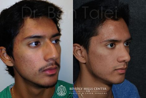 male celebrity rhinoplasty before and after