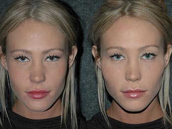 Beverly Hills Center Female Patient Before and After Non-surgical Cheek Procedure