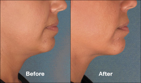 Kybella – Before & Afters | Beverly Hills Center