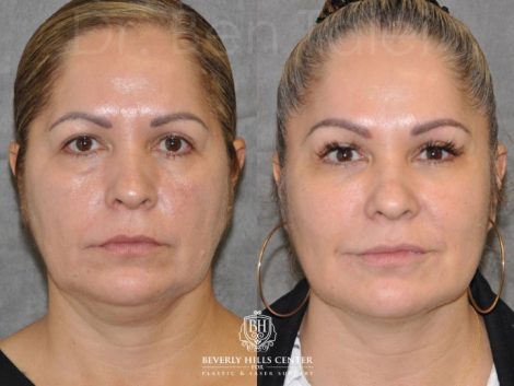 Non-Surgical Face Lift places near you in Newton, NC - March, 2024