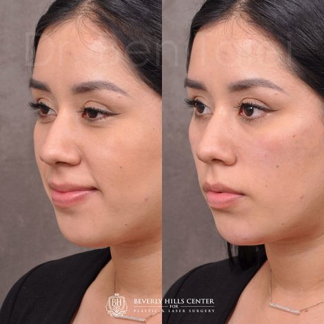 🥇 Non Surgical – Before & Afters