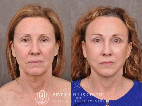 Skin – Before & Afters | Beverly Hills Center