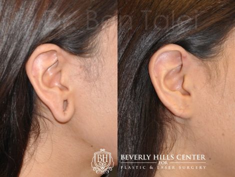 5 Questions People Ask Before an Earlobe Reconstruction Surgery - Plastic  Surgeon Beverly Hills, California