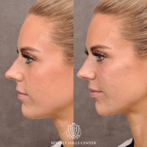 Chin – Before & Afters | Beverly Hills Center