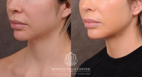 Patient 149342194  Profound RF Skin Tightening Before & After