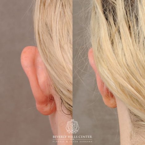 Lift Plastic Surgery - This is a 24-year-old Male patient who got his ears  pierced 1 year ago and since then began developing massive keloids - even  after removing his earrings. The