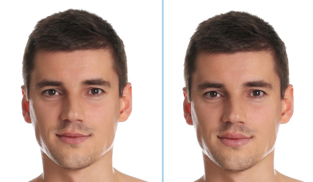 man before and after lip lift